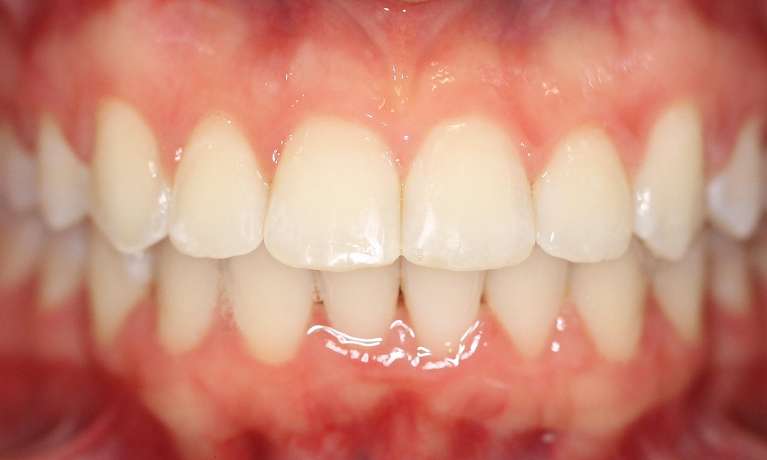 Orthodontic-Treatment-After-Image