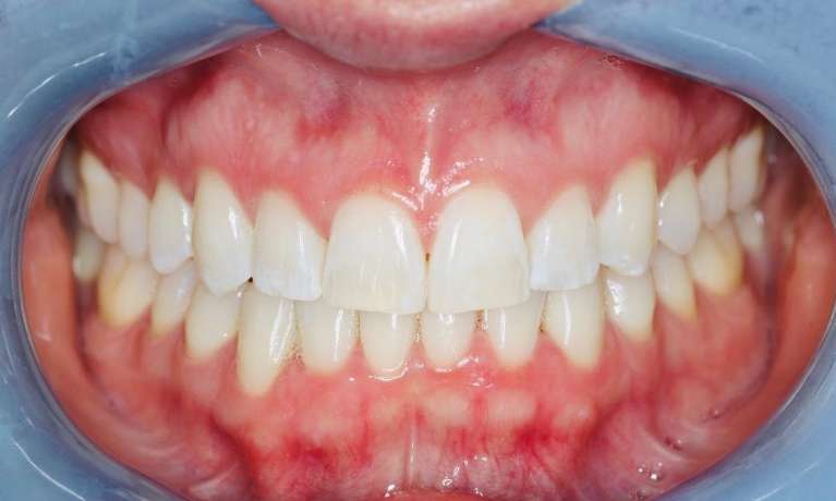 Orthodontic-Treatment-After-Image