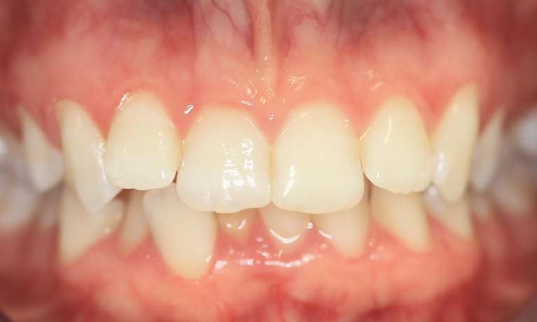 Orthodontic-Treatment-Before-Image