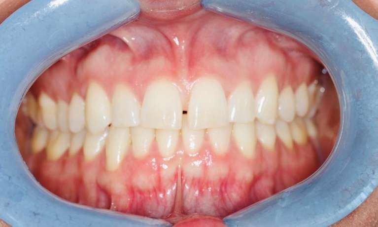 Orthodontic-Treatment-Before-Image